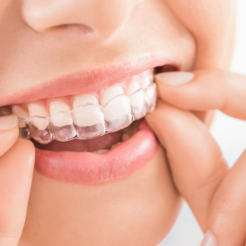 Invisalign treatment at Northview Dental Practice